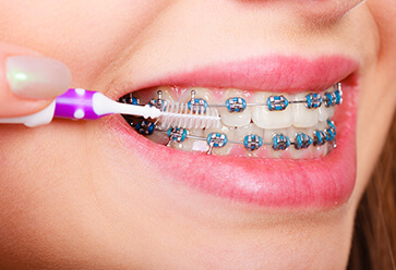 Braces