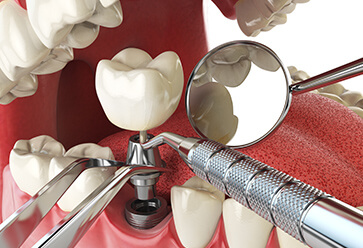 Dental Implants
