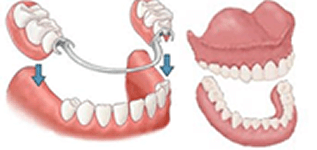 Denture