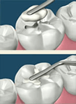 fillings