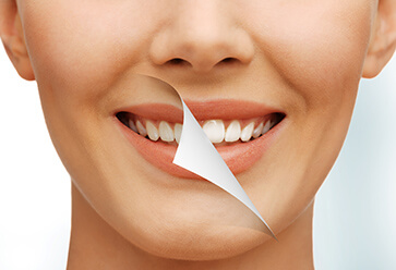 Teeth Whitening