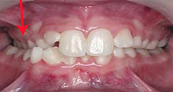 Crossbite-of-Back-Teeth