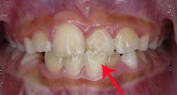 Crossbite-of-Front-Teeth