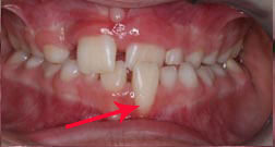 Gingival-Recession