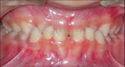 Underbite