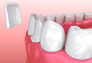 Veneers