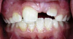 Impacted-permanent-tooth